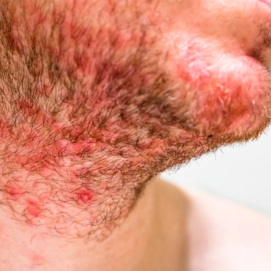 La dermatitis seborreica del cuero cabelludo