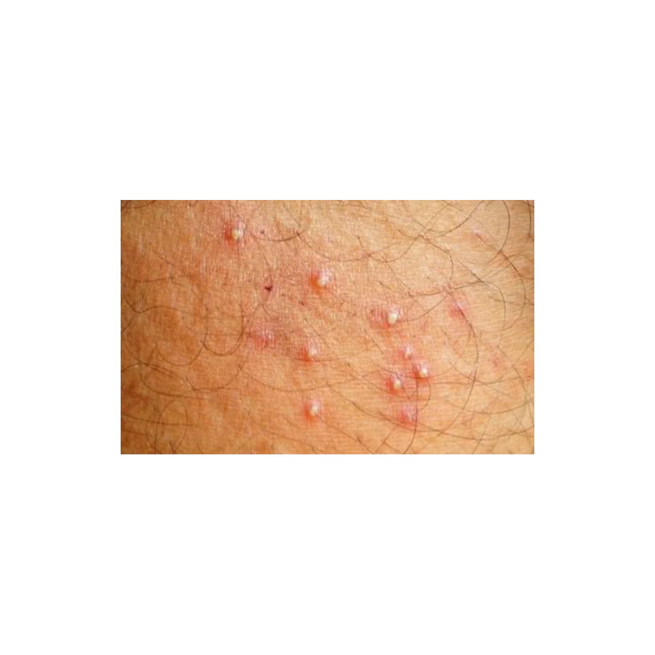 Foliculitis