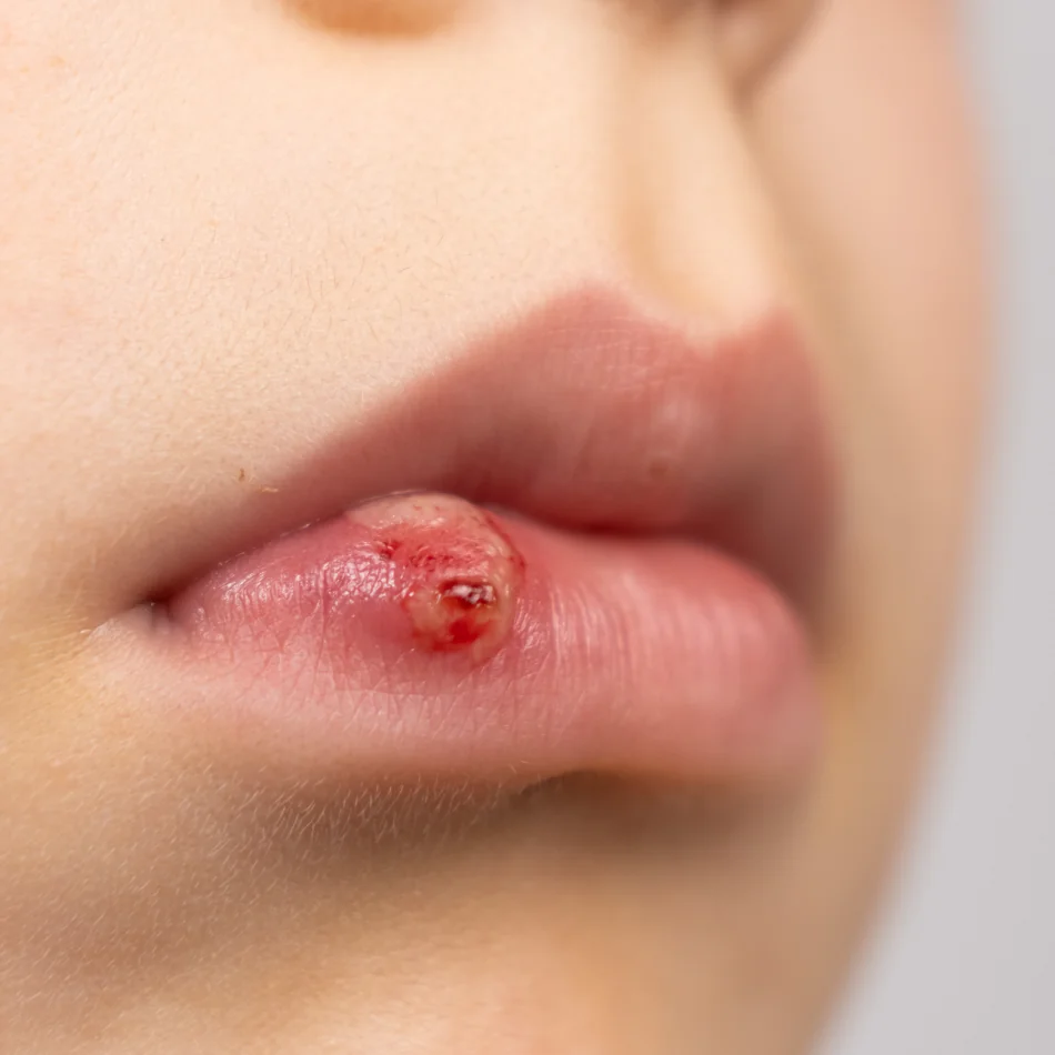 Herpes