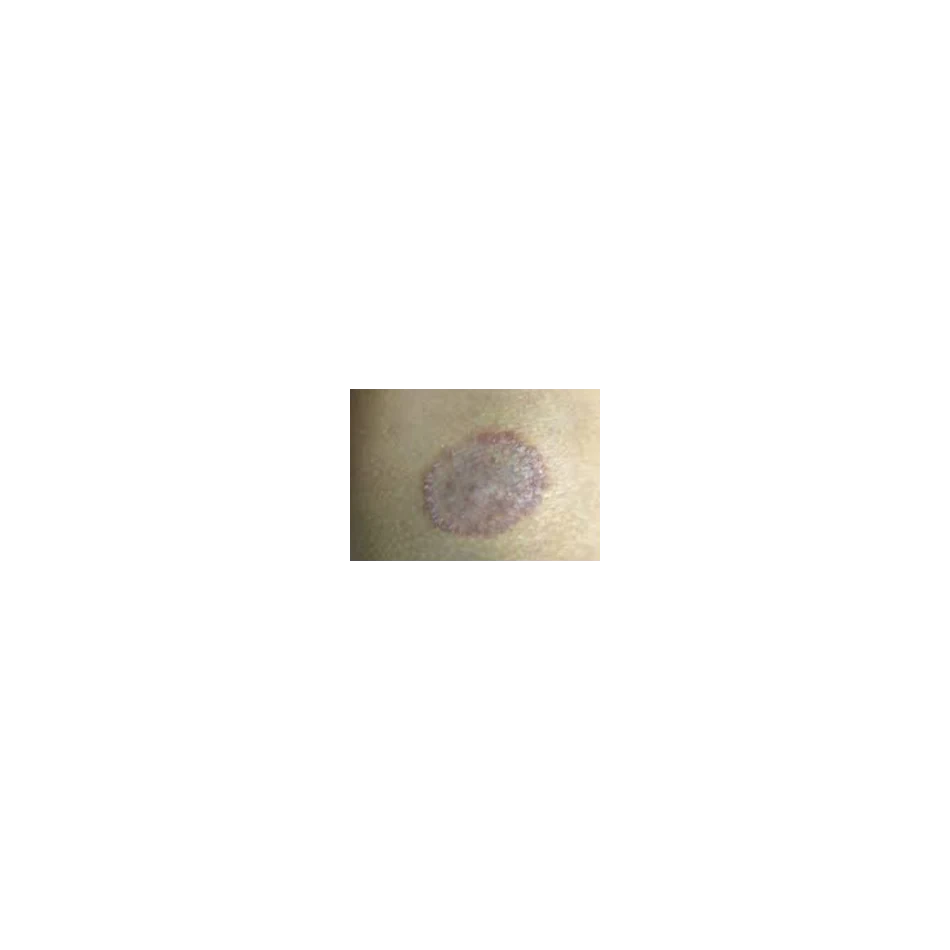 Micosis Cutáneas