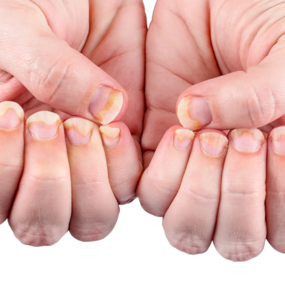 Onicomicosis