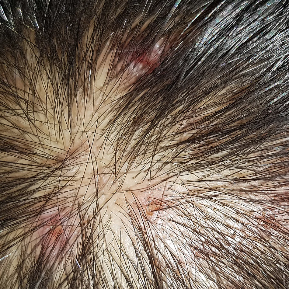 Psoriasis del Cuero Cabelludo