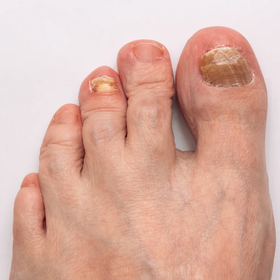Psoriasis Ungueal
