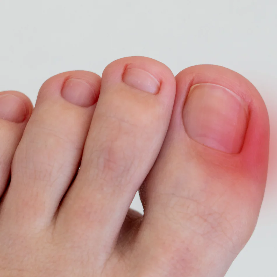 Uñas Encarnadas