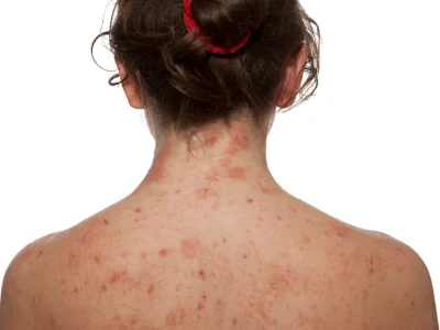 Dermatitis Atopica
