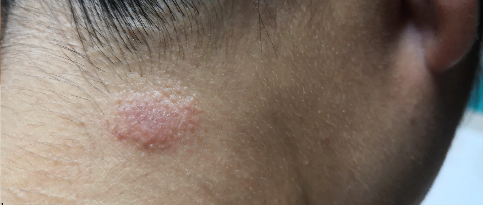 Eliminación de Verrugas Virales en Clínica Estética: Tratamientos Seguros y Eficaces