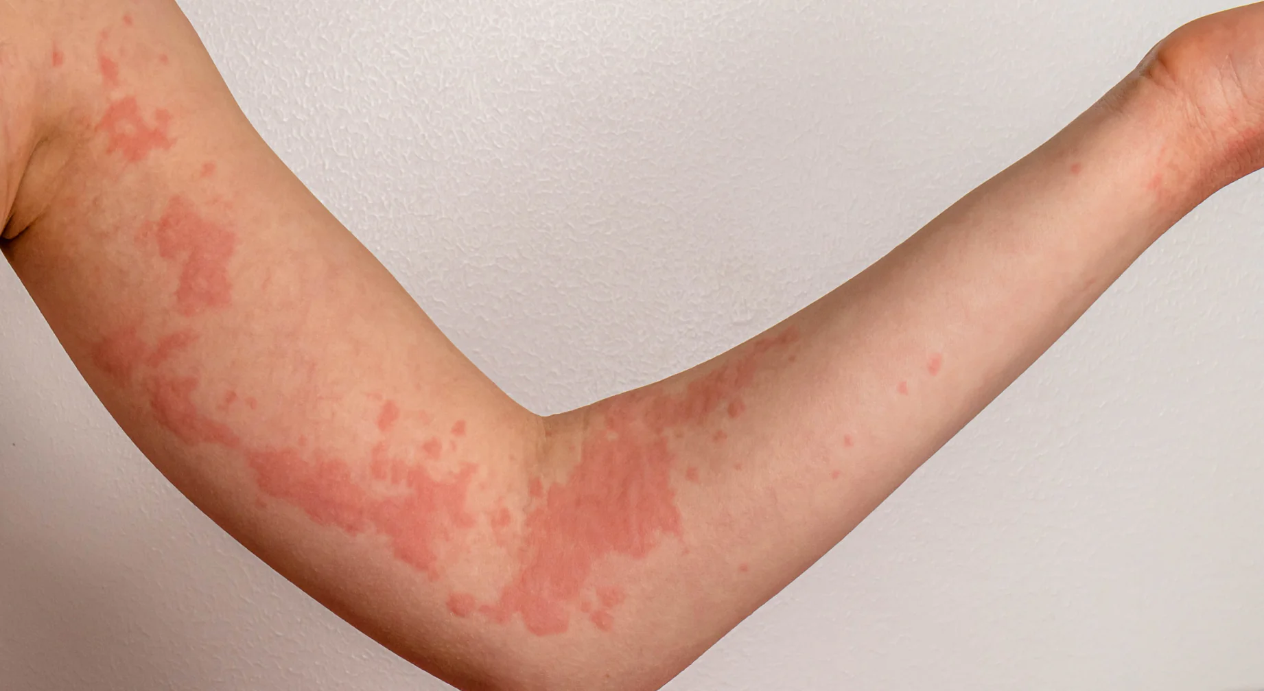Urticaria Crónica